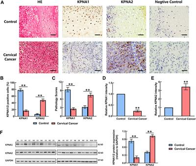 Decreased Expression of Karyopherin-α 1 is Related to the Malignant Degree of Cervical Cancer and is Critical for the Proliferation of Hela Cells